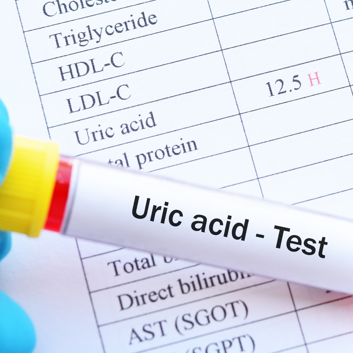 High Uric Acid